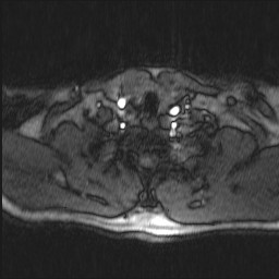 Carotid artery dissection (Radiopaedia 28441-28689 Axial MRA 12).jpg