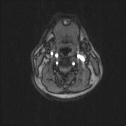 Carotid artery dissection (Radiopaedia 28441-28689 Axial MRA 41).jpg
