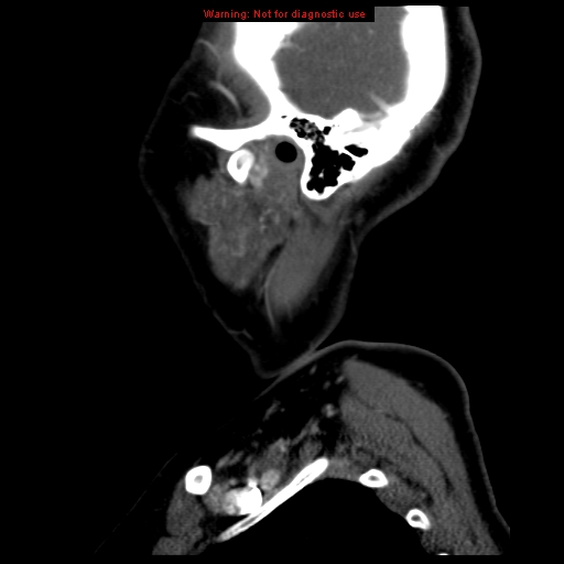 Carotid body tumor with lung metastases (Radiopaedia 9301-9986 Sagittal C+ delayed 48).jpg