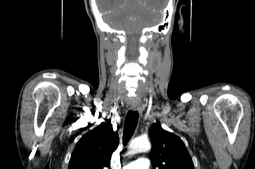 File:Carotid bulb pseudoaneurysm (Radiopaedia 57670-64616 C 47).jpg