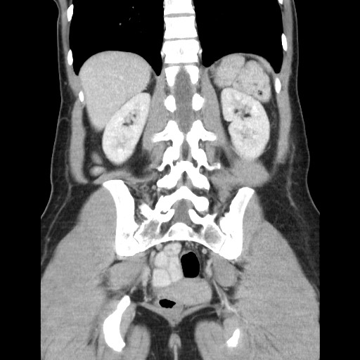 Castleman disease with fibrous pseudotumor in the abdomen (Radiopaedia 77296-89373 B 69).jpg