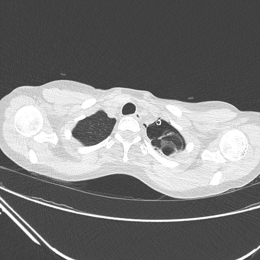 Catamenial pneumothorax (Radiopaedia 27946-28197 lung window 26).jpg