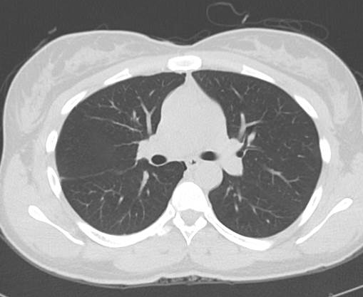 File:Catamenial pneumothorax (Radiopaedia 54382-60600 Axial 5).png