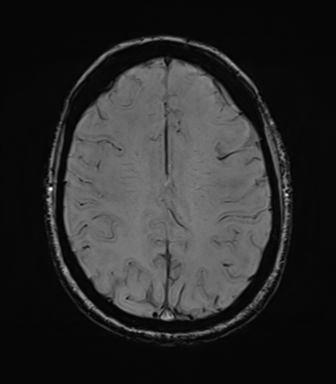 File:Cavernoma with bleed - midbrain (Radiopaedia 54546-60773 Axial SWI 34).png