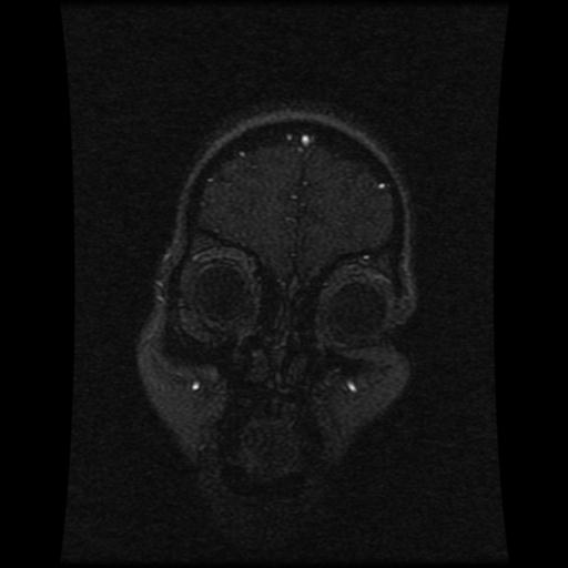 Cavernoma with developmental venous anomaly (Radiopaedia 22470-22507 MRV 111).jpg