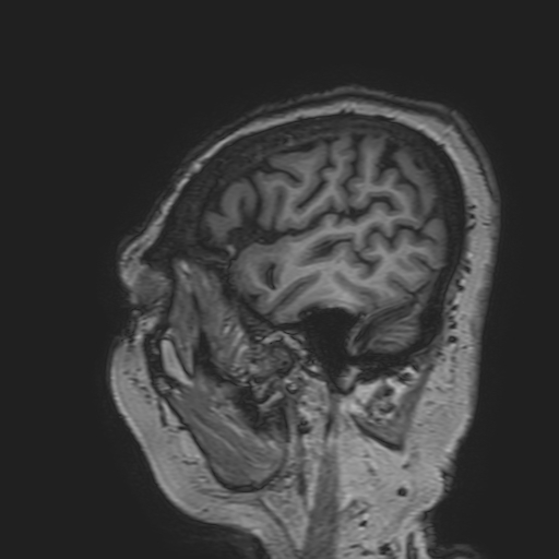 File:Cavernous hemangioma of the cerebellar falx (Radiopaedia 73025-83724 Sagittal T1 33).jpg