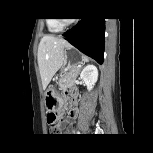 Cavernous hepatic hemangioma (Radiopaedia 75441-86667 D 129).jpg