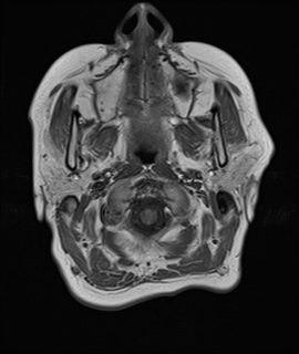File:Cavernous sinus meningioma (Radiopaedia 63682-72367 Axial T1 1).jpg