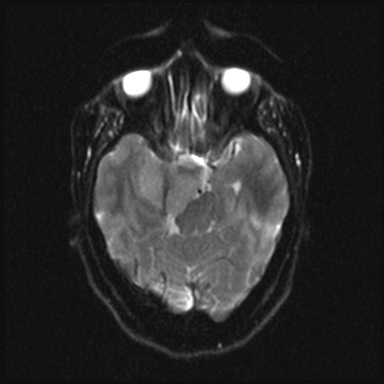 Cavernous sinus meningioma (Radiopaedia 63682-72367 DWI 9).jpg