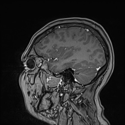 Cavernous sinus meningioma (Radiopaedia 63682-72367 Sagittal T1 C+ 126).jpg