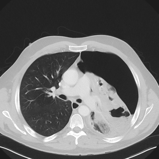 Cavitating pneumonia complicated by pneumothorax (Radiopaedia 48149-52994 Axial lung window 30).png