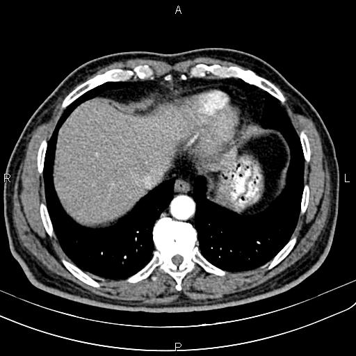 Cecal cancer with appendiceal mucocele (Radiopaedia 91080-108651 A 52).jpg