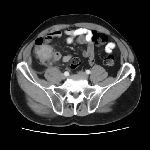 Cecal mass causing appendicitis (Radiopaedia 59207-66531 A 63).jpg