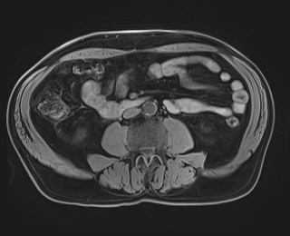Cecal mass causing appendicitis (Radiopaedia 59207-66532 Axial T1 77).jpg