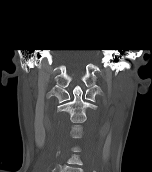 Cemento-ossifying fibroma (Radiopaedia 46243-50643 Coronal bone window 42).png