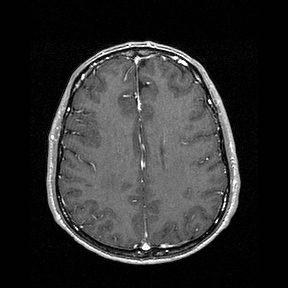 File:Central-variant posterior reversible encephalopathy syndrome (PRES) (Radiopaedia 43880-47358 Axial T1 C+ 113).jpg