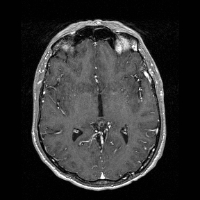 Central-variant posterior reversible encephalopathy syndrome (PRES) (Radiopaedia 43880-47358 Axial T1 C+ 77).jpg