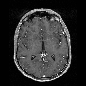 Central-variant posterior reversible encephalopathy syndrome (PRES) (Radiopaedia 43880-47358 Axial T1 C+ 79).jpg