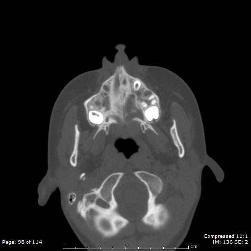 File:Central giant cell granuloma (Radiopaedia 45612-49754 Axial bone window 49).jpg