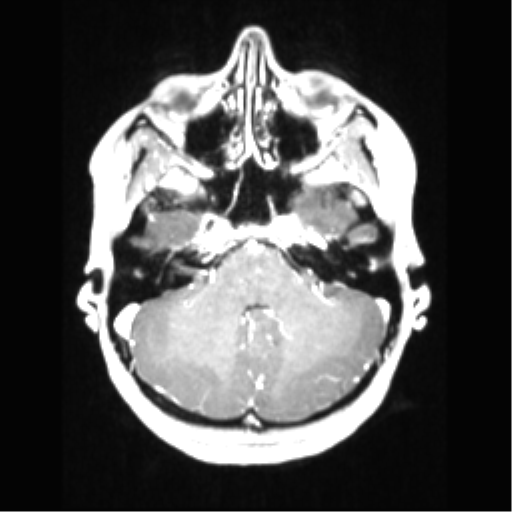 Central neurocytoma (Radiopaedia 37664-39557 Axial T1 C+ 21).png