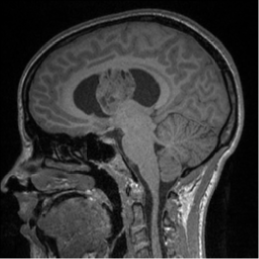 Central neurocytoma (Radiopaedia 37664-39557 Sagittal T1 46).png