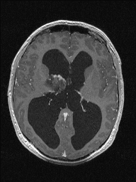 Central neurocytoma (Radiopaedia 56690-63469 Axial T1 C+ 85).jpg