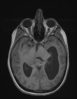 Central neurocytoma (Radiopaedia 84497-99872 Axial T1 89).jpg