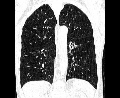 Centrilobular pulmonary emphysema (Radiopaedia 62468-70718 Coronal lung window 48).jpg