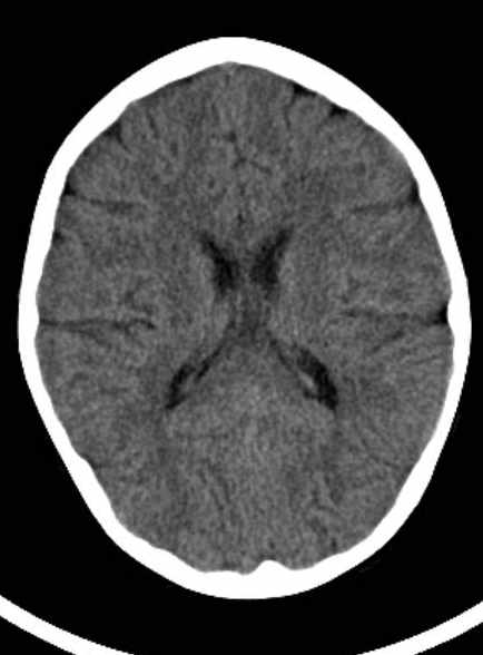 Cerebellar abscess (Radiopaedia 73727-84527 Axial non-contrast 43).jpg