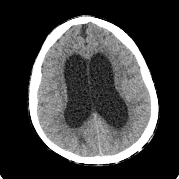 Cerebellar abscess secondary to mastoiditis (Radiopaedia 26284-26412 Axial non-contrast 102).jpg