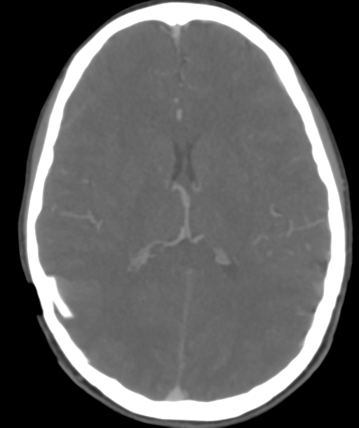 Cerebellar arteriovenous malformation- with hemorrhage (Radiopaedia 35752-37297 B 30).png