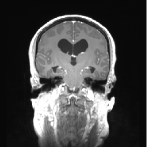 Cerebellar ependymoma complicated by post-operative subdural hematoma (Radiopaedia 83322-97736 Coronal T1 C+ 29).png