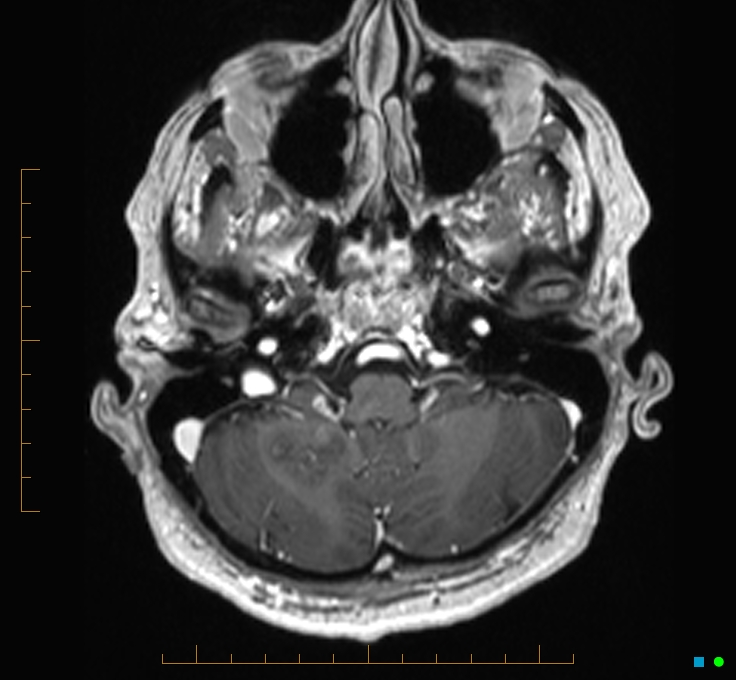 Cerebellar gangliocytoma (Radiopaedia 65377-74422 Axial T1 C+ 17).jpg