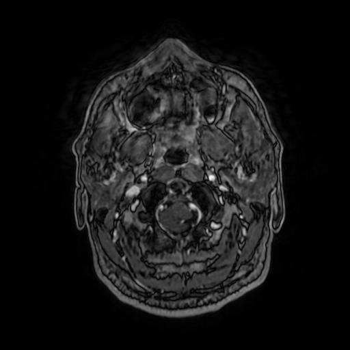 Cerebellar hemangioblastoma (Radiopaedia 88055-104622 Axial T1 C+ 26).jpg