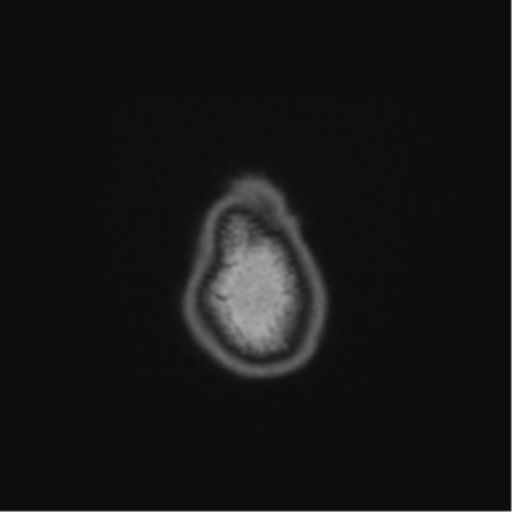 Cerebellar hemangioblastomas and pituitary adenoma (Radiopaedia 85490-101176 Axial T1 73).png