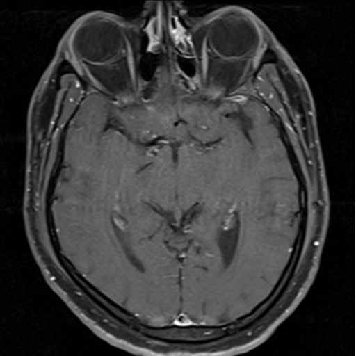 File:Cerebellar hemangioblastomas and pituitary adenoma (Radiopaedia 85490-101176 Axial T1 C+ fat sat 19).png