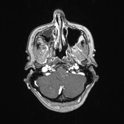File:Cerebellar metastases (Radiopaedia 24038-24249 Axial T1 C+ 50).jpg