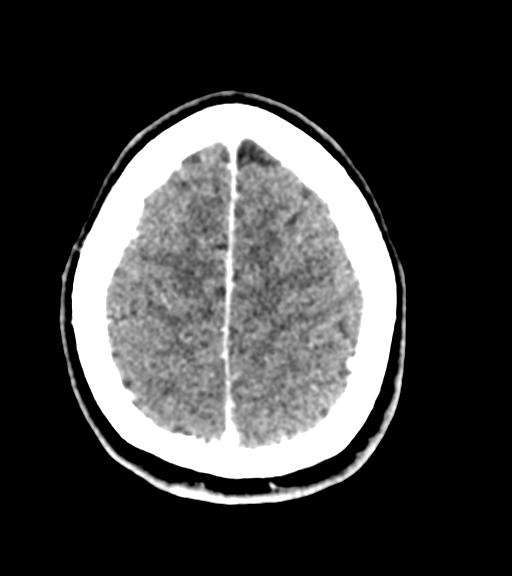 Cerebellar metastases - colorectal adenocarcinoma (Radiopaedia 40947-43652 Axial C+ 54).png