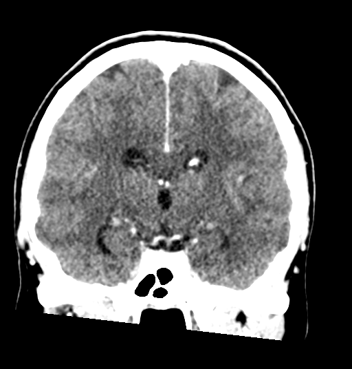 Cerebellar metastases - colorectal adenocarcinoma (Radiopaedia 40947-43652 Coronal C+ 50).png