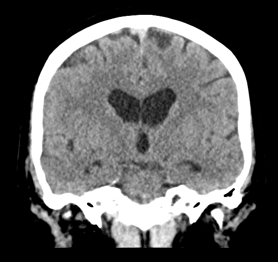 File:Cerebellar metastasis (Radiopaedia 54578-60812 Coronal non-contrast 28).png