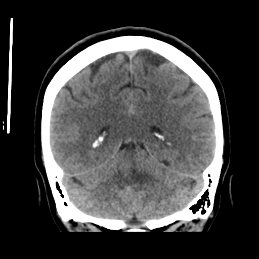 File:Cerebellar metastasis (cystic appearance) (Radiopaedia 41395-44258 Coronal non-contrast 43).png