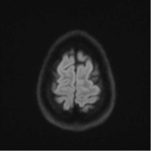 Cerebellar metastasis - adenocarcinoma lung (Radiopaedia 63184-71715 Axial DWI 55).png