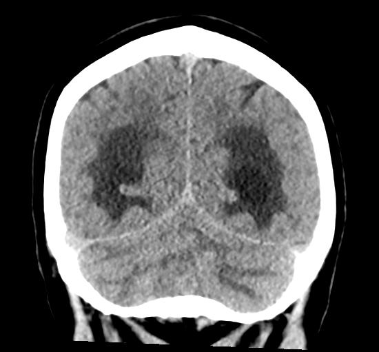 File:Cerebellar metastasis from lung adenocarcinoma (Radiopaedia 86690-102828 Coronal non-contrast 31).png
