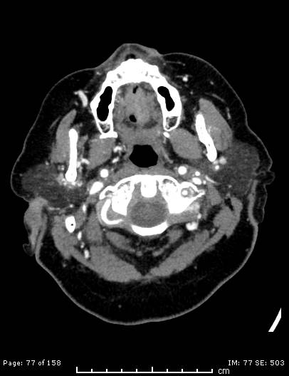 Cerebellar strokes due to intracranial giant cell arteritis (Radiopaedia 68799-78510 CT angiogram 77).jpg