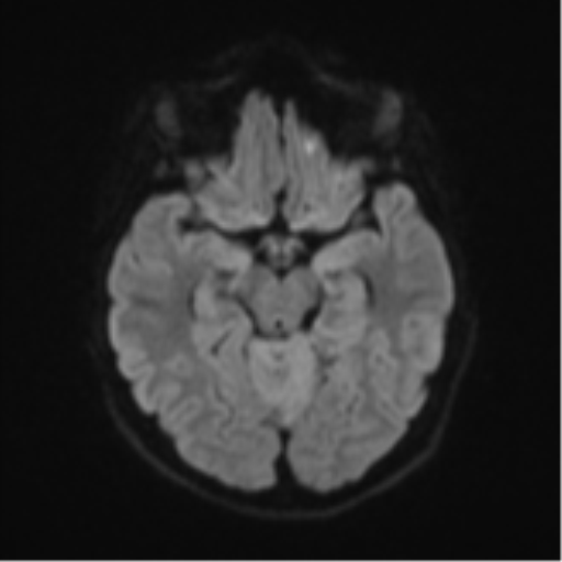 Cerebellar tuberculomas (Radiopaedia 46939-51472 Axial DWI 40).png