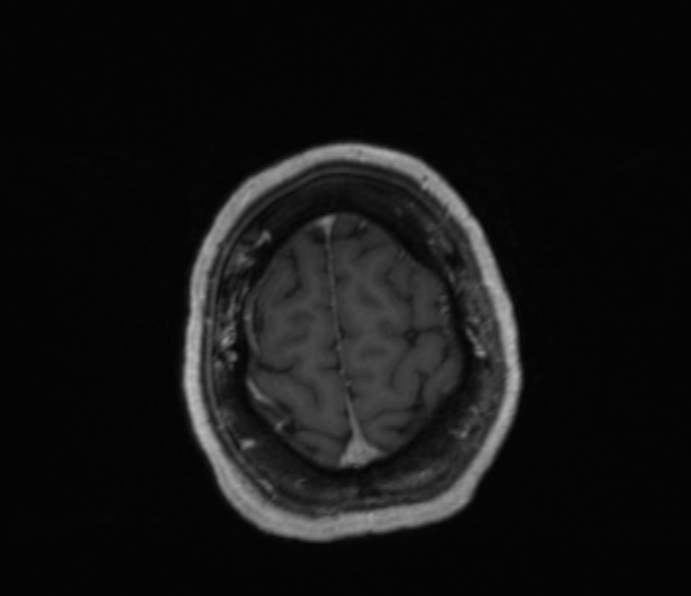 Cerebellopontine angle meningioma (Radiopaedia 35181-36715 Axial T1 C+ 10).jpg