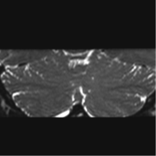 Cerebellopontine angle meningioma (Radiopaedia 48434-53348 Coronal T2 8).png