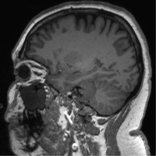 File:Cerebellopontine angle meningioma (Radiopaedia 48434-53348 Sagittal T1 34).png