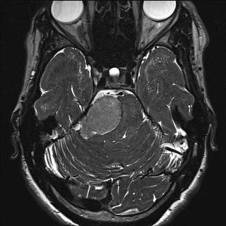 Cerebellopontine angle meningioma (Radiopaedia 72983-83680 Axial FIESTA 46).jpg