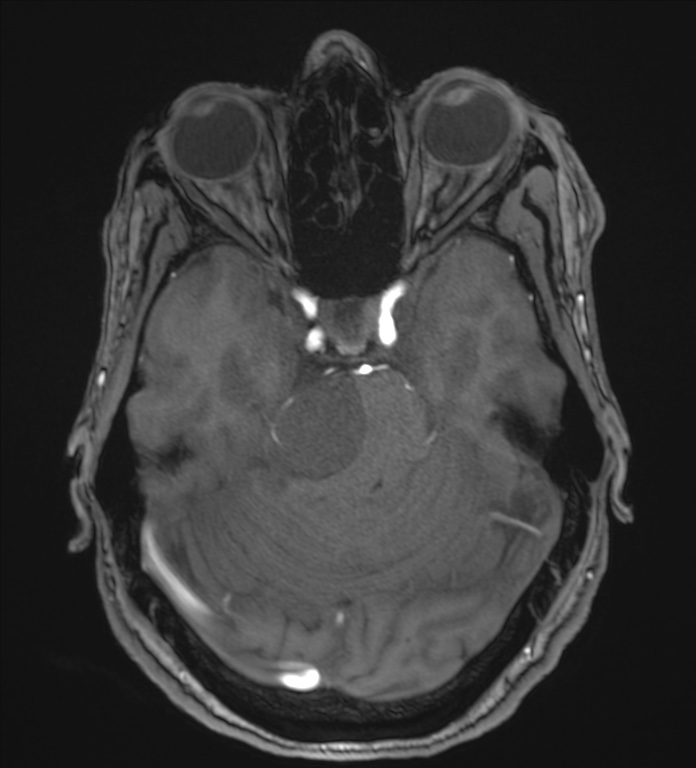 Cerebellopontine angle meningioma (Radiopaedia 72983-83680 Axial MRA 39).jpg